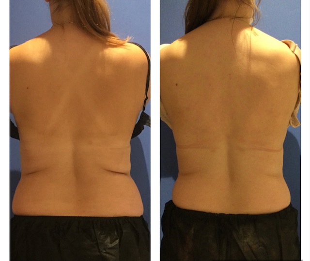 3 months post 2 cycles